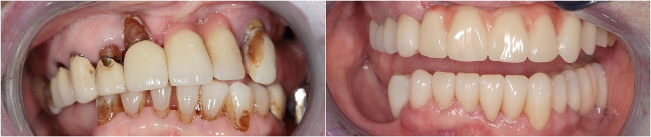 3D-Planung. Extraktion der Zähne im Oberkiefer. Implantatinstallation mit einer chirurgischen Schablone