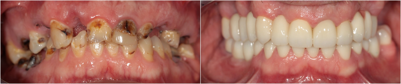 Root canal treatment. Prosthetic. 3D planning. Installation of implants. Zirconium crowns and bridges on the own teeth.