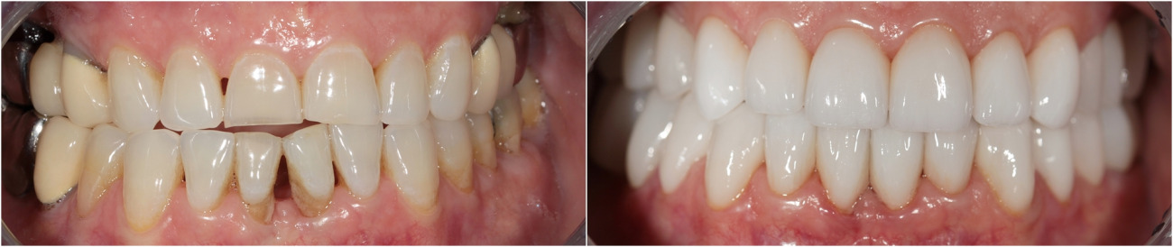 Complex prosthetic with ceramic veneers by technologies CEREC in the frontal teeth. Zirconium crowns and bridges in the lateral teeth.