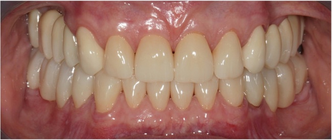 Complex prothetic of teeth. Full Bite Reconstruction. Zirconium crowns and bridges.